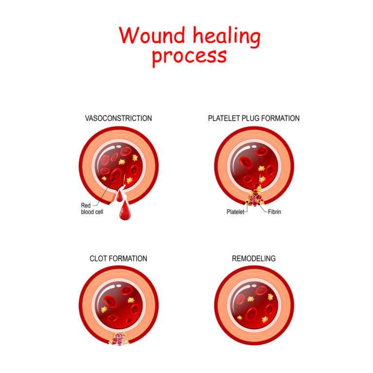 Phases of the wound healing process. poster with capillary, red blood